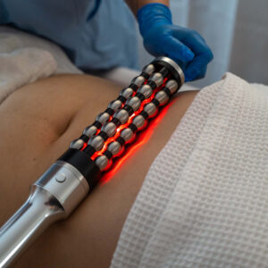 RF Endosphere Therapy